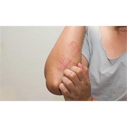 راه اندازی آزمون خورندگی/ تحریک زایی حاد پوستی درون تن